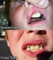Before and after tooth